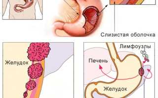 Перстневидноклеточная карцинома желудка