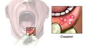 3 стадии опасного заболевания! Как выглядит стоматит во рту, на языке, деснах и губах