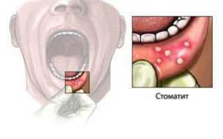 3 стадии опасного заболевания! Как выглядит стоматит во рту, на языке, деснах и губах