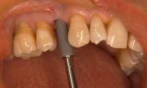 Классический метод, проверенный временем — двухэтапная имплантация зубов