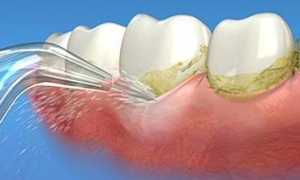 Поддержит здоровье зубов: обзор разных моделей ирригаторов для полости рта