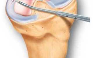 Перелом надколенника