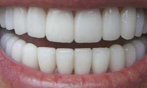 Такая желанная белоснежная улыбка: как отбелить зубы в домашних условиях?