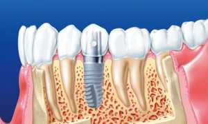 Установка зубных имплантов: технология совершенной улыбки