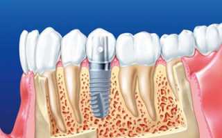 Установка зубных имплантов: технология совершенной улыбки