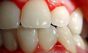 Катаральный гингивит: этиология, симптоматика, особенности течения, методы лечения