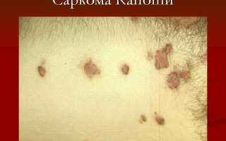 Симптомы и лечение саркомы Капоши