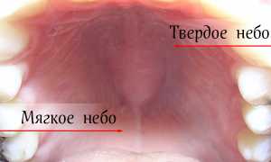 Рак нёба: диагностика, симптомы и лечение