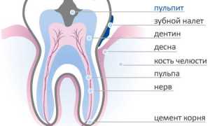 Острый очаговый пульпит, его особенности и лечение