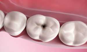 Такое разнообразие видов одного заболевания! Редкие формы пульпита: какие самые необычные?