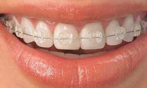 Правда ли, что они совсем непривлекательны? Как выглядят брекеты на зубах: фото
