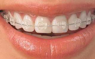 Правда ли, что они совсем непривлекательны? Как выглядят брекеты на зубах: фото