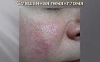 Симптомы и лечение гемангиомы