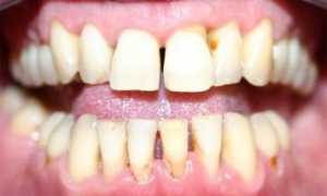 Какие причины провоцируют развитие пародонтита?