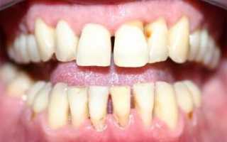 Какие причины провоцируют развитие пародонтита?