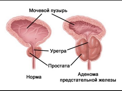 Профилактика аденомы простаты у мужчин