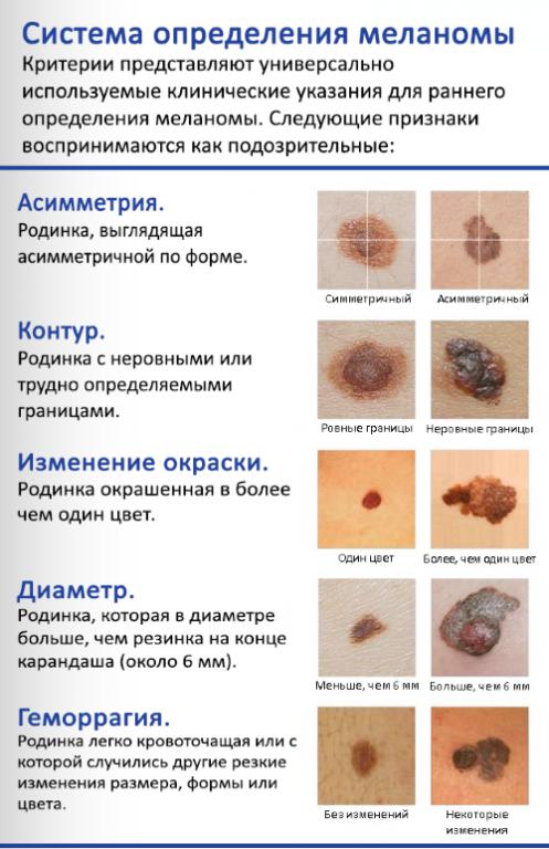 Можно ли вылечить меланому?