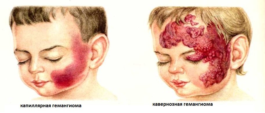 Венозная опухоль