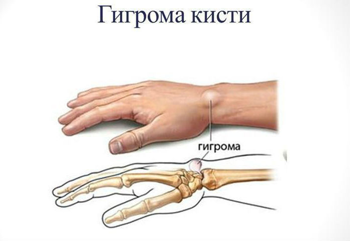Лечение гигромы в домашних условиях