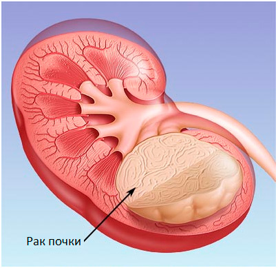 Рак почек