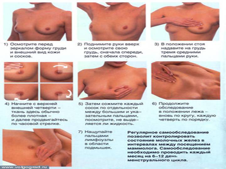 Фиброаденома молочной железы