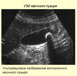 УЗД желчи