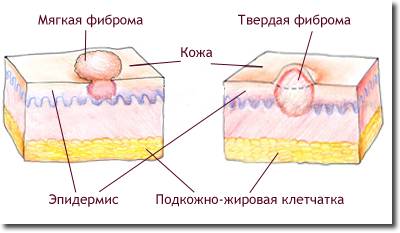 Фиброма кожи