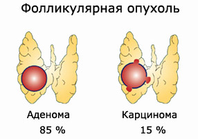 Фолликулярная опухоль щитовидки