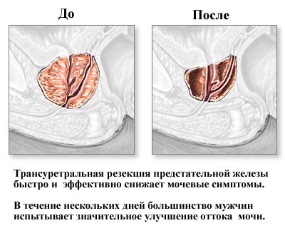 Аденома простаты лечение: ТУР