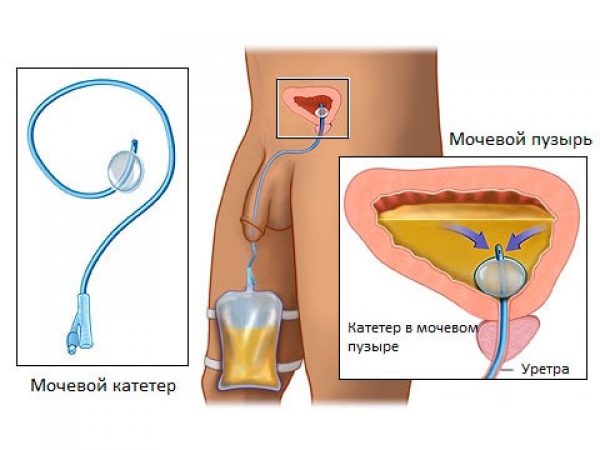 Аденома задержки мочи