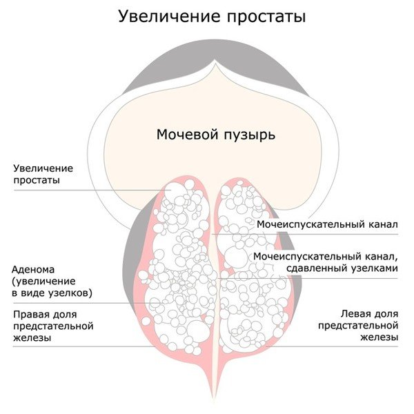 Рак аденома предстательной железы. Симптомы и лечение
