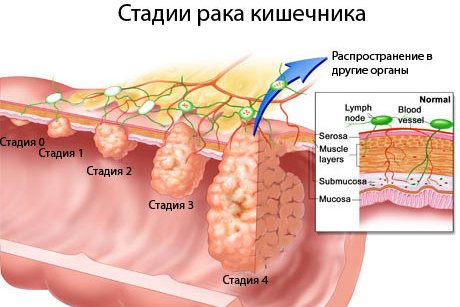 стадии лимфом