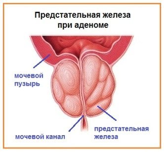 Осложнения после удаления аденомы предстательной железы