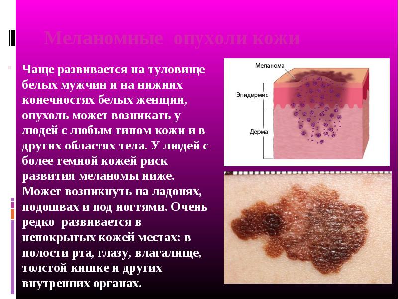 Виды меланомы