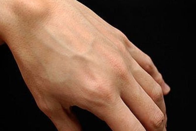 Гигрома на кисти руки