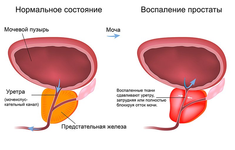 Питание при аденоме простаты у мужчины