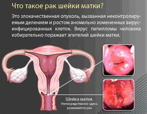 Симптомы рака шейки матки