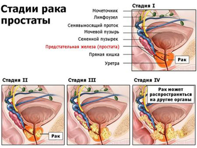Рак простаты