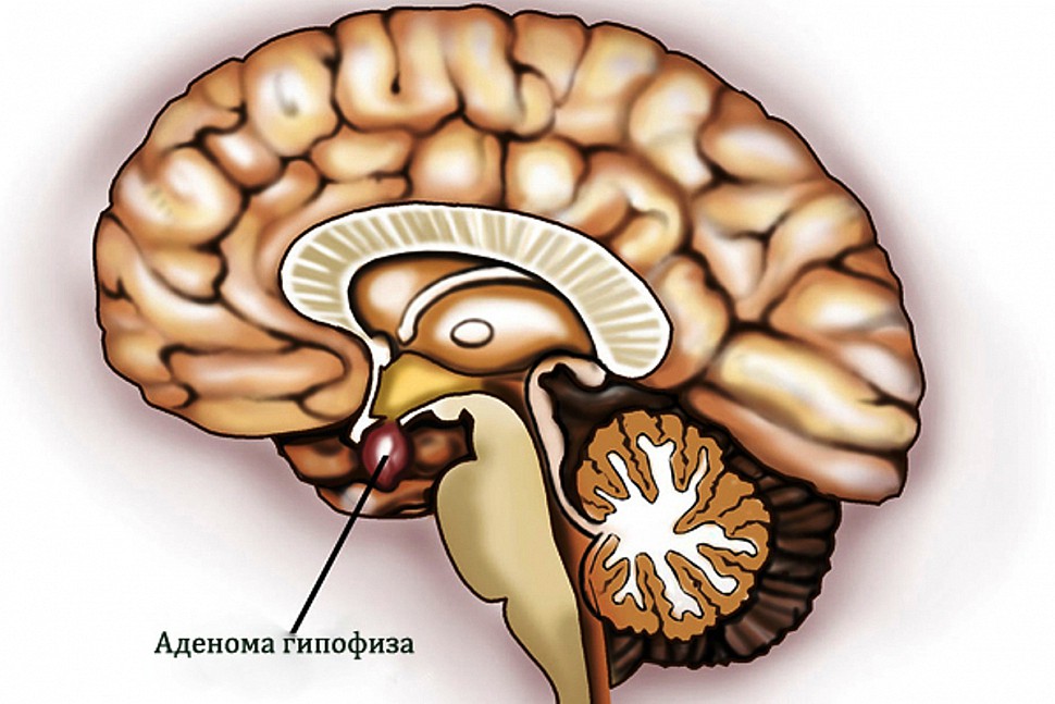 Опухоль ЦНС