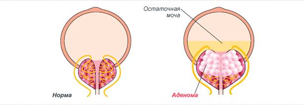 Аденома.Остаточная моча
