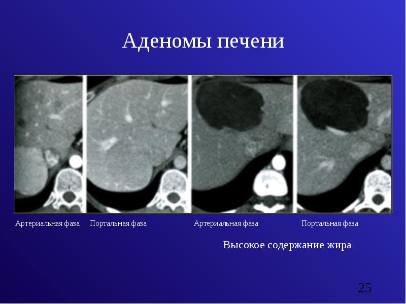Аденома печени