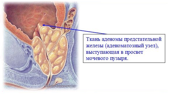 Рост аденомы простаты