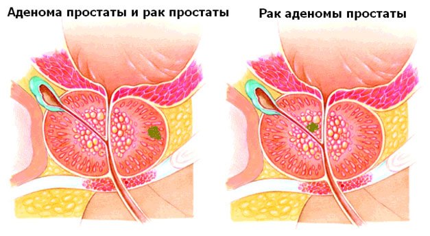 Аденома ПСА норма