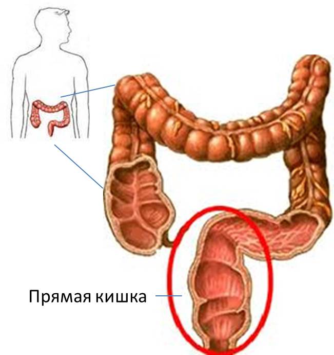 Аденома прямой кишки