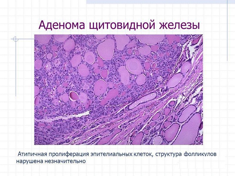 Аденома щитовидной железы