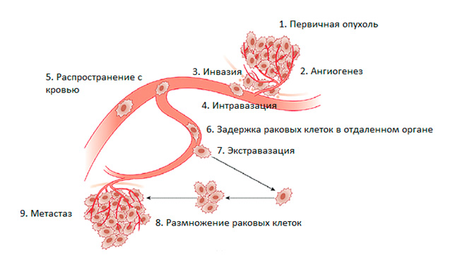 Что такое метастазы?