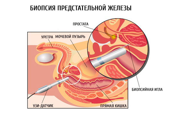 Биопсия предстательной железы