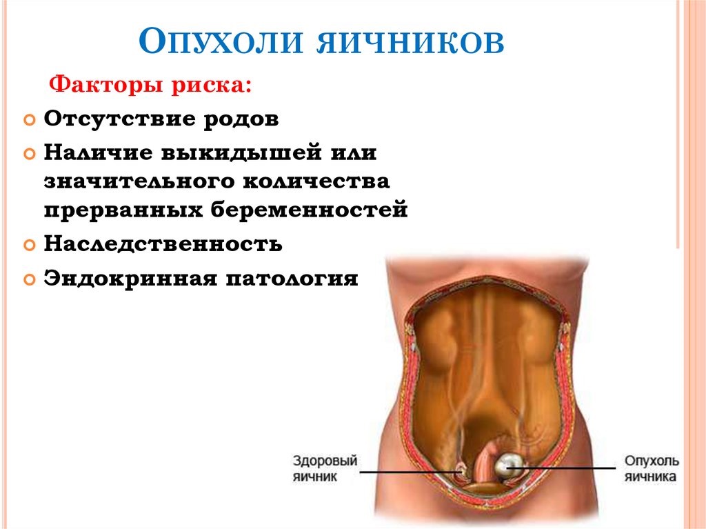 Бластома яичника