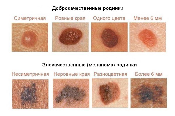 Бластома кожи