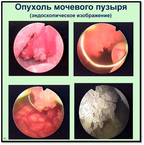 Что такое бластома мочевого пузыря?